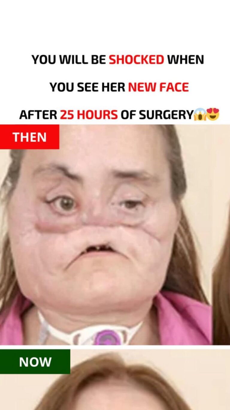 A lady from the United States describes her new life after the most thorough face transplant ever performed…
