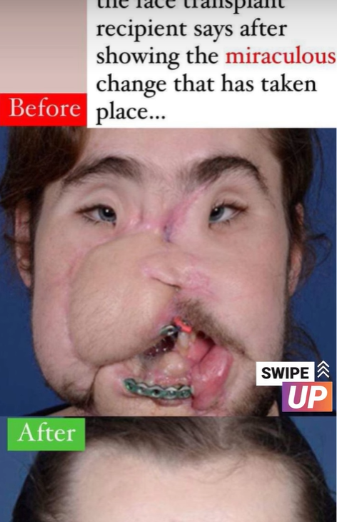 “It’s been well worth it,” the face transplant recipient says after showing the miraculous change that has taken place…