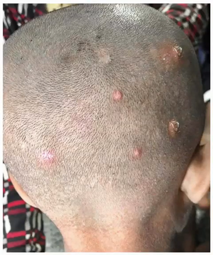 I Found Strange Bumps on My Son’s Head — Then Came the Panic