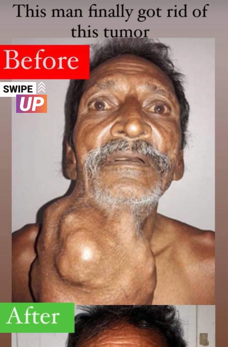 After ignoring a lump for 20 years, a man with a 1.4 kg tumor finally receives surgery that will change his life…